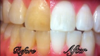 How To Whiten Teeth at Home in 3 Minutes - SIMPLE