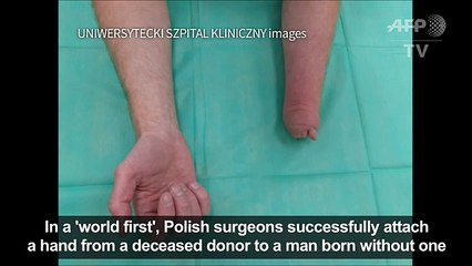 Polish surgeons succesfully attach hand to man born without one