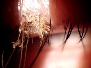 Cette femme croit avoir une infection à l'œil, mais le diagnostic fera bondir votre cœur de dégoût ! - vidéo Dailymotion