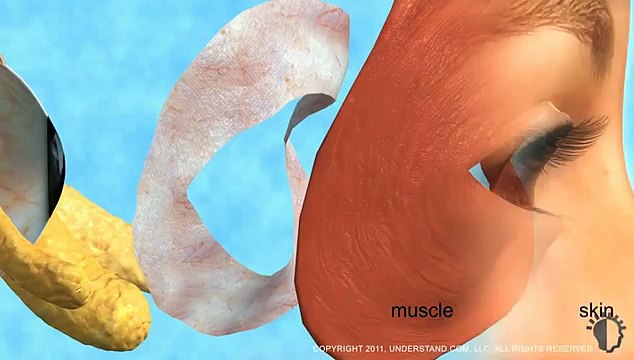 Eyelid Surgery (Blepharoplasty)Op.Dr.M.METE