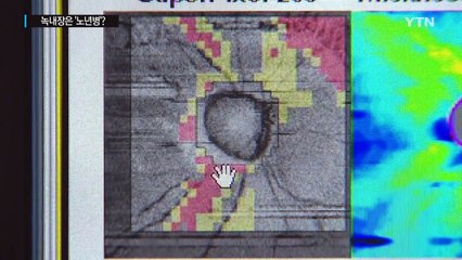 '실명 3대 원인' 녹내장, '노년병?'...20~30대도 '위험!' / YTN (Yes! Top News)