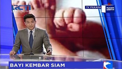 Salah Satu Bayi Kembar Siam Asal Probolinggo Meninggal