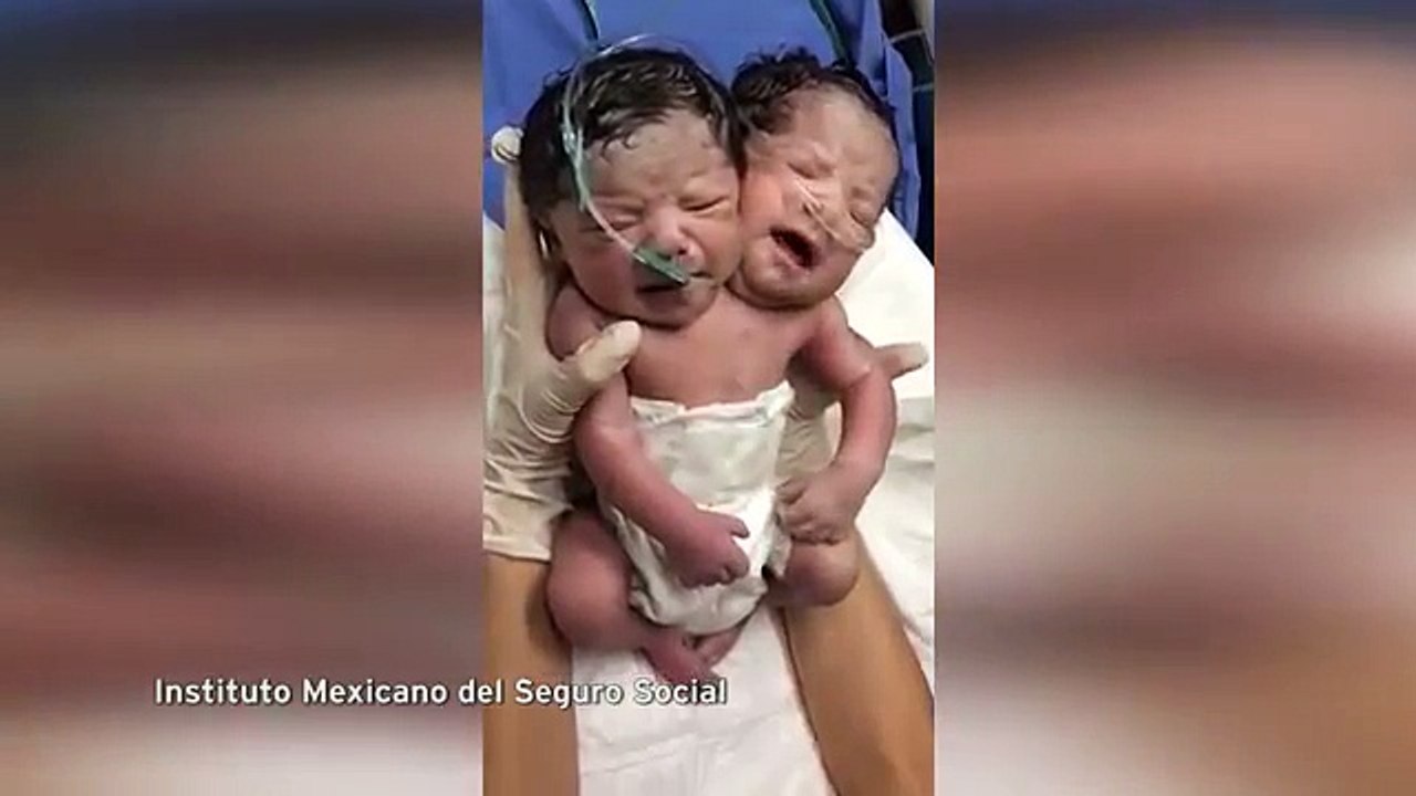 Bebé Nasce Com Duas Cabeças Em Um Corpo Deixando Médicos Confusos E Parentes Incrédulos!