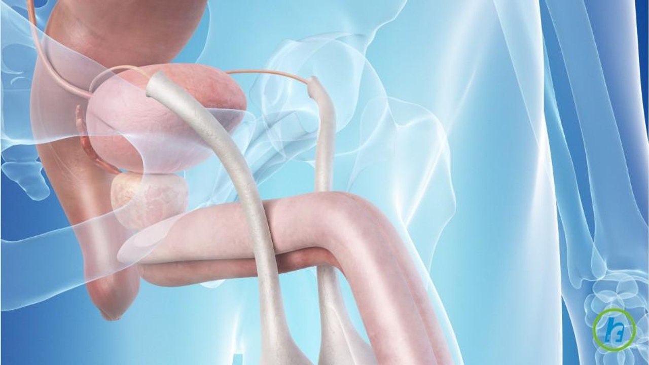 What is a Vasectomy?