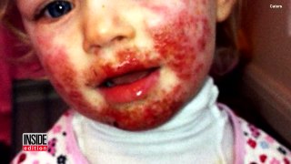 Mom of Girl Stricken With Severe Case of Herpes Says Daughter Finally Recovering-244z7GidDV8