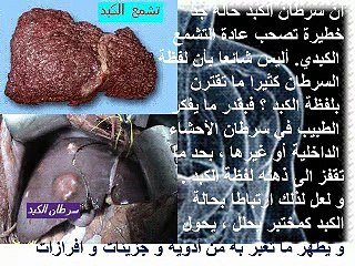 Le cancer du foie - carcinome hépatocellulaire GASTRO CASABLANCA-