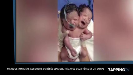 Une mère accouche d'un bébé à deux têtes (vidéo)