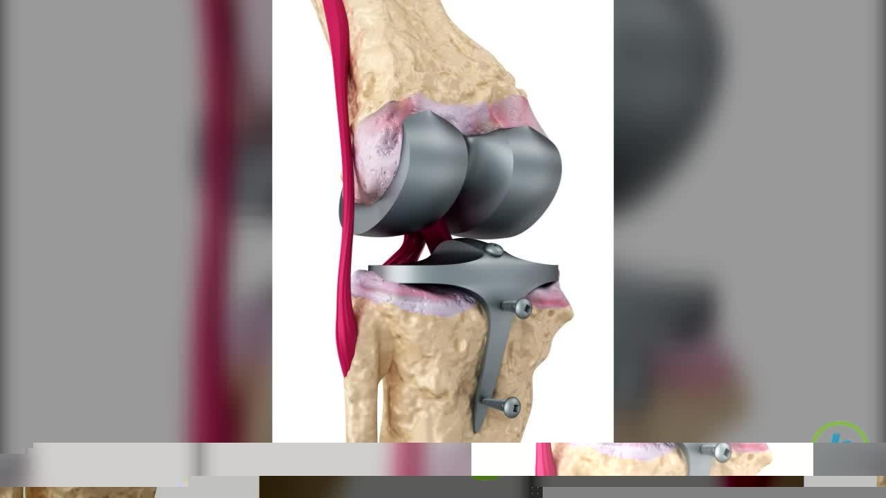 What is an Anterior Cruciate Ligament Surgery?