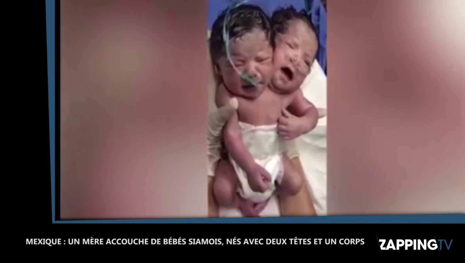 Une Mere Accouche D Un Bebe A Deux Tetes Video Dailymotion