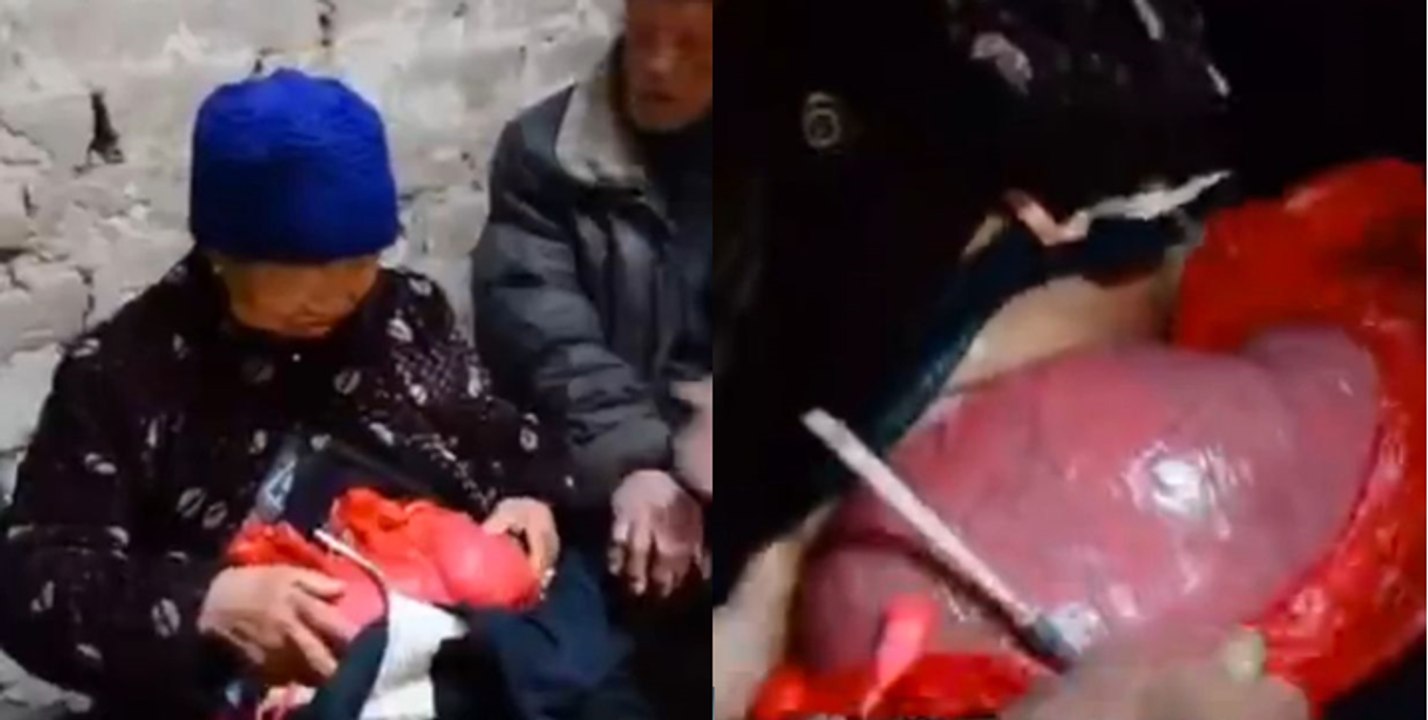 Este Mulher Vive Com Os Intestinos Fora Do Corpo Em Sacos De Compras À Mais De 20 Anos!