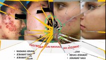 HP 085 728 237 840 Obat Penghilang Jerawat Batu Yang Membandel Dan Alami Di Apotik