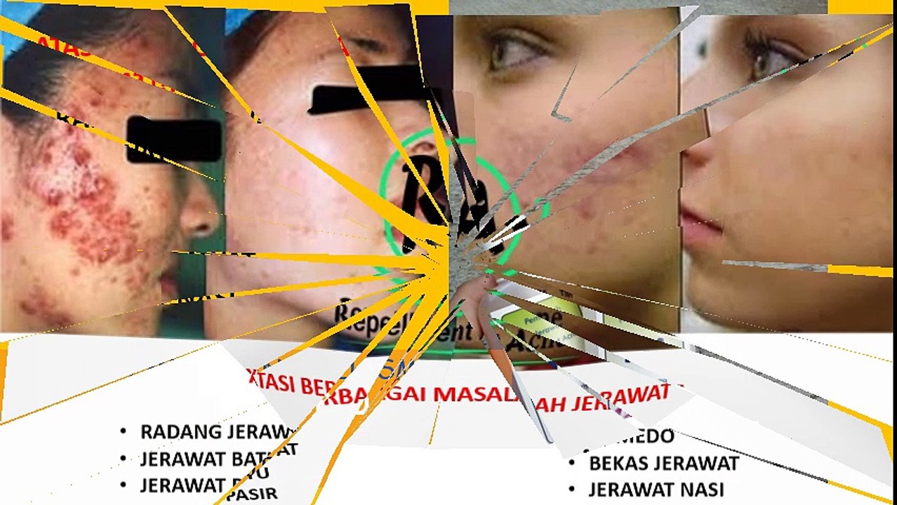 HP 085 728 237 840 Cara Menghilangkan Jerawat Batu Dan Bekasnya Dengan Obat Di Apotik