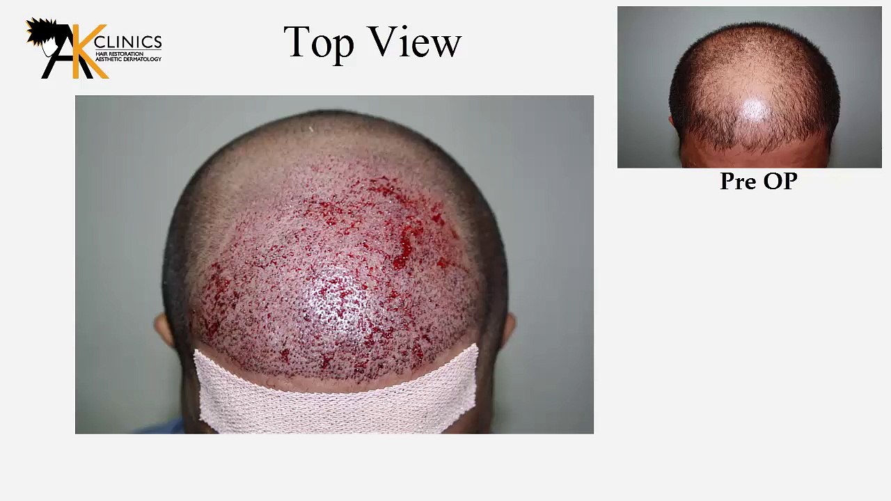 2530 Grafts, FUE Hair Transplant Surgery result after 3 years, India