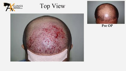 2530 Grafts, FUE Hair Transplant Surgery result after 3 years, India