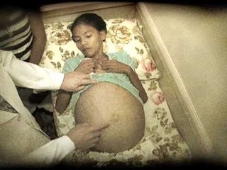 Pinoy MD: "Big Tummy, Without a Baby"