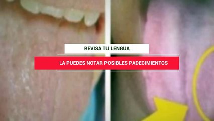 Revisa Tu Lengua De Vez En Cuando, Averigua Las Posibles Enfermedades Que Pudieras Padecer