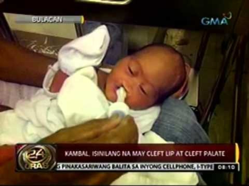 24 Oras: Kambal na may Cleft Lip at Cleft Palate, humihingi ng tulong