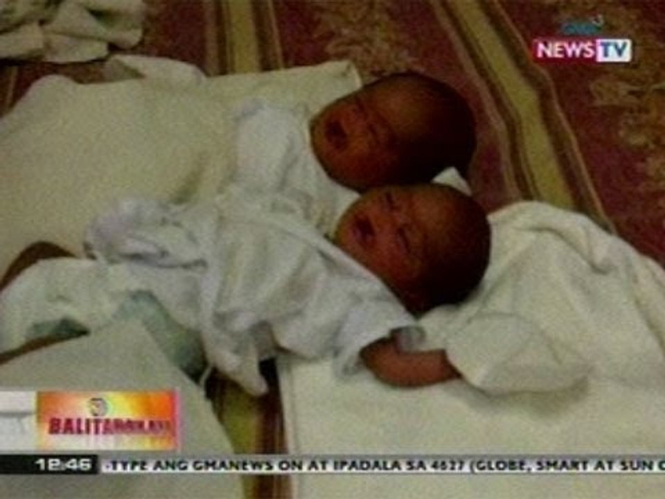 BT: Kambal na isinilang na may cleft lift at cleft palate o bingot sa Bulacan, nananawagan ng tulong