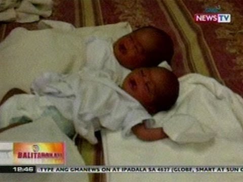 BT: Kambal na isinilang na may cleft lift at cleft palate o bingot sa Bulacan, nananawagan ng tulong