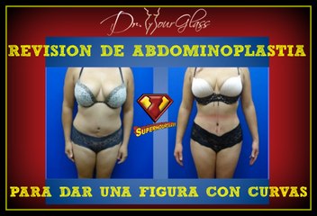 Revisión de una abdominoplastia para dar una figura con curvas