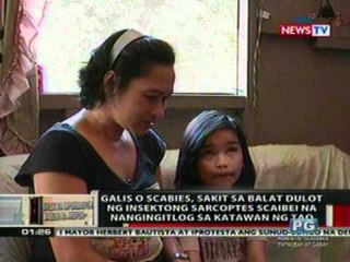 OC:  Galis, sakit sa balat na dulot ng insektong Sarcoptes Scaibei na nangingitlog sa katawan ng tao