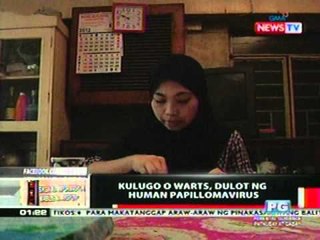 OC: Kulugo o warts, dulot ng Human   Papillomavirus