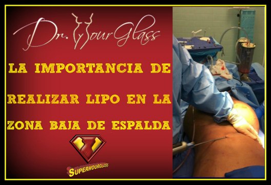 La importancia de realizar liposucción en la zona baja de la espalda y flancos durante una abdominoplastia