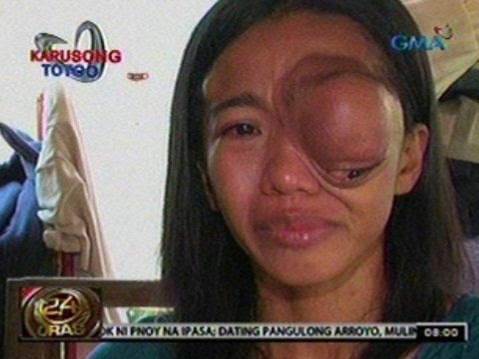 24 Oras: Inang may malaking bukol sa mata, nagpapakatatag para sa