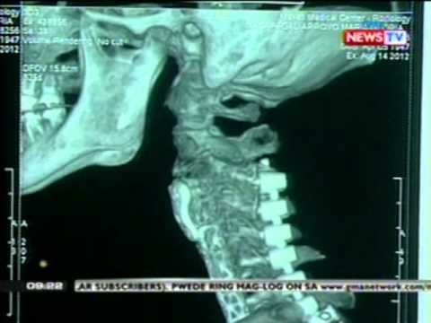 Rep. Arroyo, nakalabas na ng ospital pero kritikal pa rin ang kondisyon, ayon sa kanyang doktor