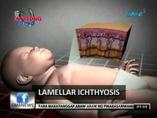 24 Oras: Sanggol na may pambihirang sakit sa balat, dumudulog ng tulong