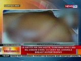 BT: 14-anyos na dalagita, sumobra ang laki ng dibdib dahil sa sakit na Juvenile Breast Hypertrophy