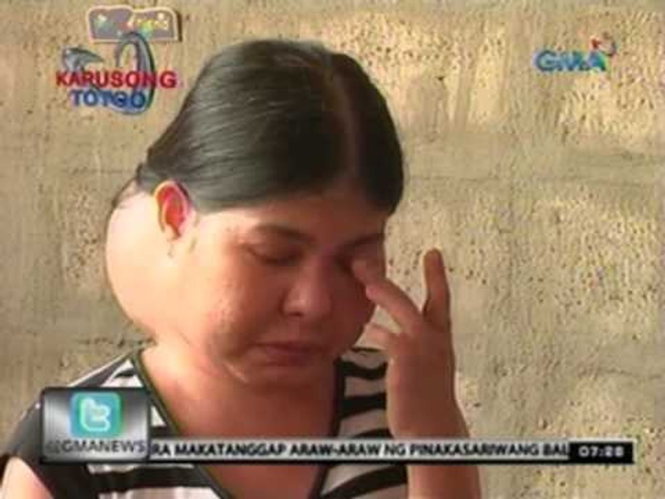 24 Oras: Ginang na iniinda ang malaking bukol sa kanyang batok, nananawagan ng tulong