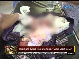 Conjoined twins, isinilang subalit wala nang buhay sa Zamboanga City