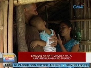 UB: Sanggol na may tumor sa mata, nangangailangan ng tulong