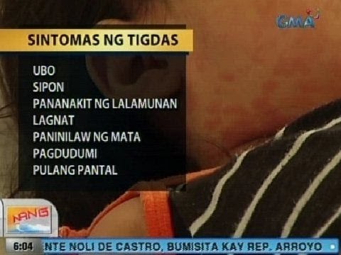 UB: Tigdas, pinangangambahang kumalat din sa mga lugar na sinalanta ng bagyo