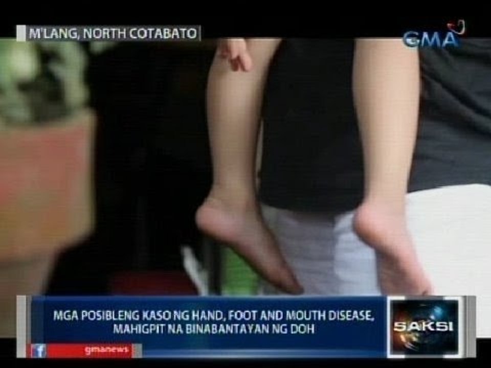 Saksi: Mga posibleng kaso ng hand, foot and mouth disease, mahigpit na binabantayan ng DOH