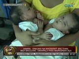 24 Oras: Kambal, isinilang na magkadikit ang tiyan; mga magulang, umaapela para maipaopera sila