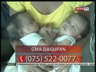 BP: Magulang ng conjoined twins sa Bautista, Pangasinan, umaapela ng tulong