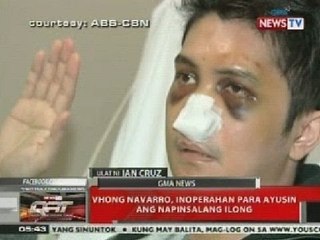 QRT: Vhong Navarro, inoperahan para ayusin ang napinsalang ilong