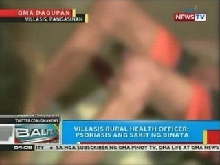 Turismo sa Pangasinan, naapektuhan na ng kumalat na balita tungkol sa sakit ng 2 residente