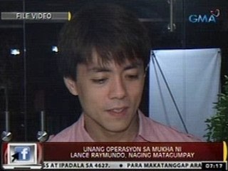 24 Oras: Unang operasyon sa mukha ni Lance Raymundo, naging matagumpay