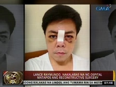 24 Oras: Lance Raymundo, nakalabas na ng ospital matapos ang reconstructive surgery