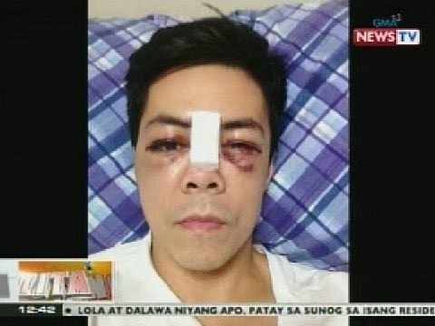 BT: Lance Raymundo, nakalabas na ng ospital matapos maoperahan sa mukha