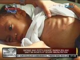 24 Oras: Batang may Pott's disease, iniinda rin ang sakit na rickets at severe malnutrition