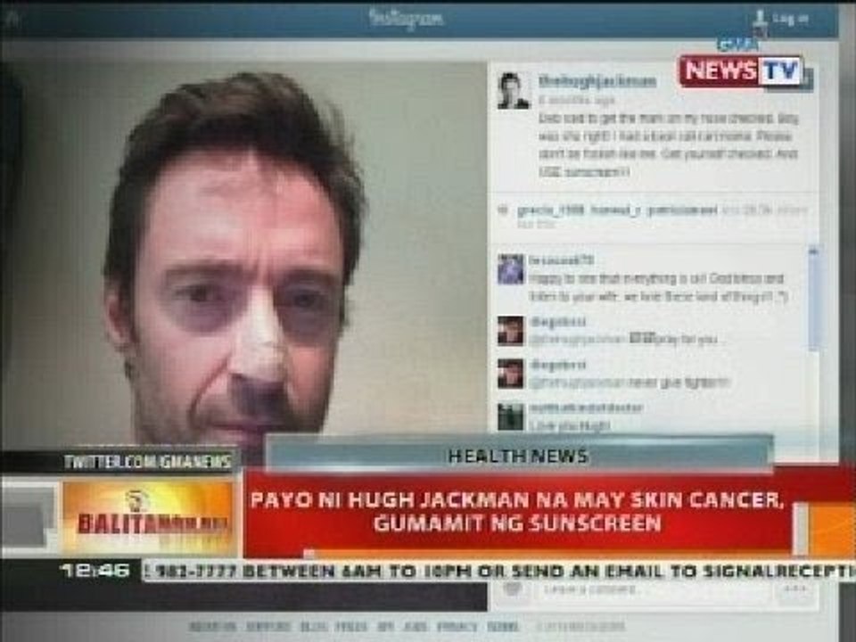 BT: Payo ni Hugh Jackman na may skin cancer, gu...