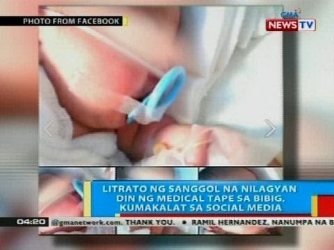 Litrato ng sanggol sa Cebu na nilagyan din ng medical tape sa bibig, kumakalat sa social media