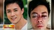 BT: Birthday at thanksgiving dinner, idinaos kasunod ng matagumpay na operasyon ni Lance Raymundo