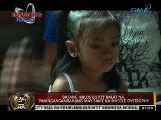 Kapusong Totoo: Batang halos buto't balat na, pingangambahang may sakit na muscle dystrophy