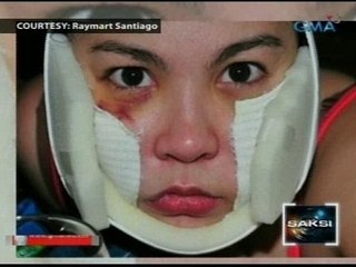 Saksi: Kampo ni Raymart: Dahil sa "post-surgical procedure" ang mga pasa ni Claudine