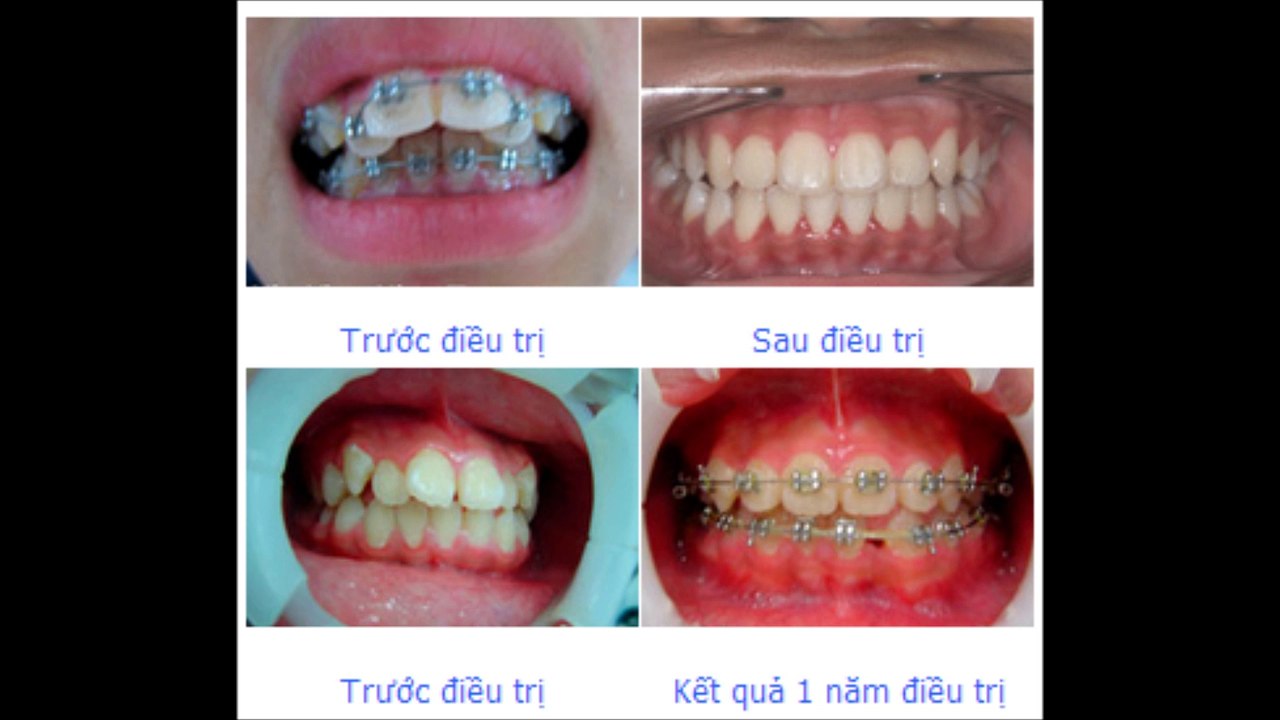 Nhakhoamedita.vn | Tẩy trắng răng hết bao nhiêu tiền tại hà nội